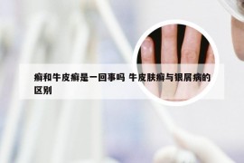 癣和牛皮癣是一回事吗 牛皮肤癣与银屑病的区别