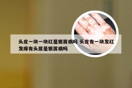 头皮一块一块红是银屑病吗 头皮有一块发红发痒有头屑是银屑病吗