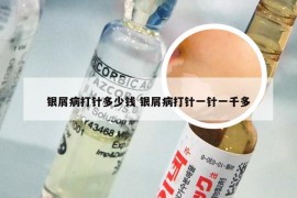 银屑病打针多少钱 银屑病打针一针一千多