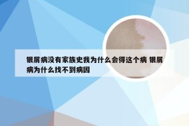 银屑病没有家族史我为什么会得这个病 银屑病为什么找不到病因