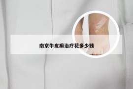 南京牛皮癣治疗花多少钱