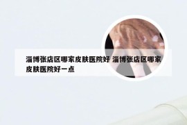 淄博张店区哪家皮肤医院好 淄博张店区哪家皮肤医院好一点