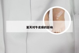夏天对牛皮癣的影响
