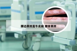 腰边黑斑是牛皮癣 腰背黑斑