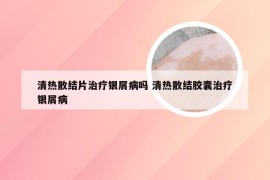 清热散结片治疗银屑病吗 清热散结胶囊治疗银屑病