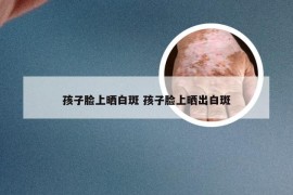 孩子脸上晒白斑 孩子脸上晒出白斑