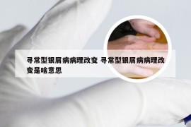 寻常型银屑病病理改变 寻常型银屑病病理改变是啥意思