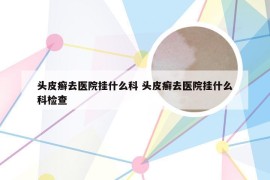 头皮癣去医院挂什么科 头皮癣去医院挂什么科检查