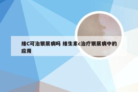 维C可治银屑病吗 维生素c治疗银屑病中的应用