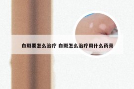 白斑要怎么治疗 白斑怎么治疗用什么药膏