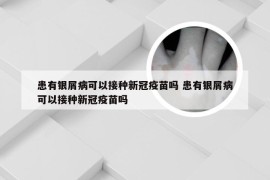患有银屑病可以接种新冠疫苗吗 患有银屑病可以接种新冠疫苗吗