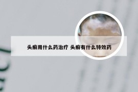 头癣用什么药治疗 头癣有什么特效药