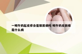 一喝牛奶起皮疹会是银屑病吗 喝牛奶皮肤痒是什么病