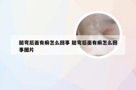 腿弯后面有癣怎么回事 腿弯后面有癣怎么回事图片