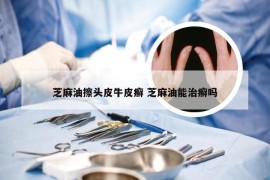芝麻油擦头皮牛皮癣 芝麻油能治癣吗