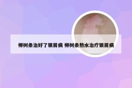 柳树条治好了银屑病 柳树条熬水治疗银屑病