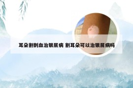 耳朵割刺血治银屑病 割耳朵可以治银屑病吗