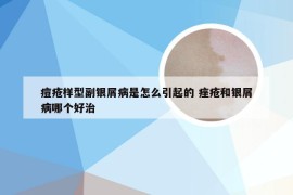 痘疮样型副银屑病是怎么引起的 痤疮和银屑病哪个好治
