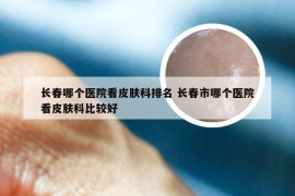 长春哪个医院看皮肤科排名 长春市哪个医院看皮肤科比较好