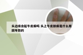 头边缘会起牛皮癣吗 头上牛皮肤癣是什么原因导致的