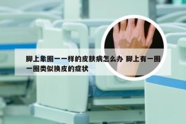 脚上象圈一一样的皮肤病怎么办 脚上有一圈一圈类似换皮的症状
