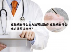 皮肤病有什么土方法可以治疗 皮肤病有什么土方法可以治疗?