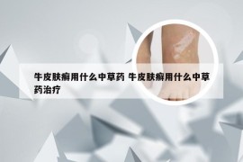 牛皮肤癣用什么中草药 牛皮肤癣用什么中草药治疗