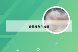 身患多年牛皮癣