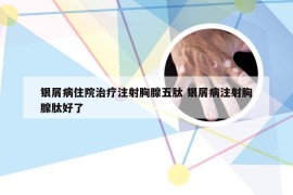 银屑病住院治疗注射胸腺五肽 银屑病注射胸腺肽好了