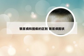 银屑病和圈癣的区别 银屑病圈状