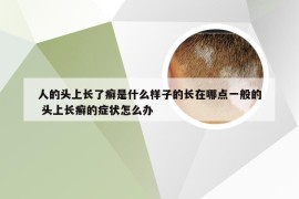 人的头上长了癣是什么样子的长在哪点一般的 头上长癣的症状怎么办