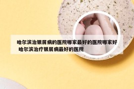 哈尔滨治银屑病的医院哪家最好的医院哪家好 哈尔滨治疗银屑病最好的医院