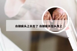 白颠疯头上长出了 白颠疯长在头发上