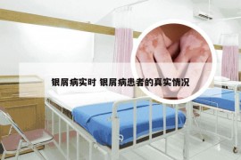 银屑病实时 银屑病患者的真实情况