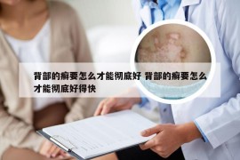 背部的癣要怎么才能彻底好 背部的癣要怎么才能彻底好得快