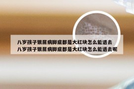 八岁孩子银屑病脚底都是大红块怎么能退去 八岁孩子银屑病脚底都是大红块怎么能退去呢
