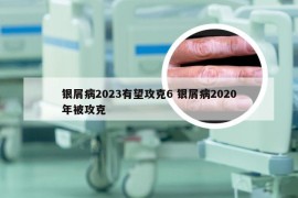 银屑病2023有望攻克6 银屑病2020年被攻克
