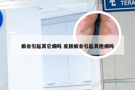 癣会引起其它病吗 皮肤癣会引起其他病吗