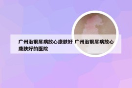 广州治银屑病放心康肤好 广州治银屑病放心康肤好的医院