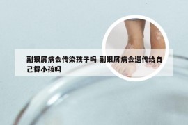 副银屑病会传染孩子吗 副银屑病会遗传给自己得小孩吗