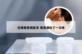 吃辣银屑病复发 银屑病吃了一次辣
