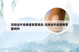 沈阳治牛皮癣道青菜拔尖 沈阳治牛皮屑哪家医院好