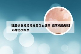 银屑病复发后发红是怎么回事 银屑病恢复期又出现小红点