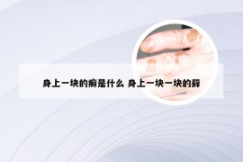 身上一块的癣是什么 身上一块一块的藓