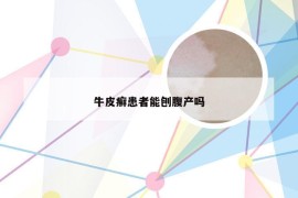 牛皮癣患者能刨腹产吗