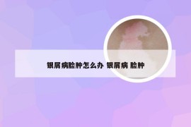 银屑病脸肿怎么办 银屑病 脸肿