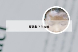 夏天长了牛皮癣