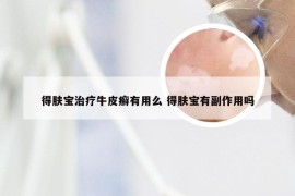得肤宝治疗牛皮癣有用么 得肤宝有副作用吗