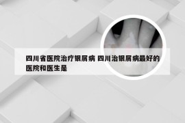 四川省医院治疗银屑病 四川治银屑病最好的医院和医生是