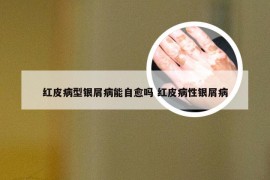 红皮病型银屑病能自愈吗 红皮病性银屑病